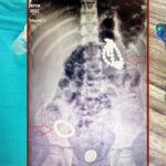 Bu oyuncak bir ölüm tuzağı! Herkesi çok şaşırtan vaka: 3 yaşında, karnında 66 adet mıknatısla aylarca yaşamış! Tehlikeye karşı uyarı: “İç organlarını deliyor”